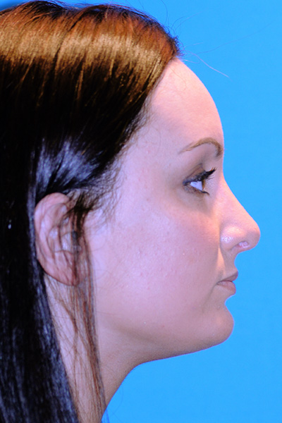 Rhinoplasty After