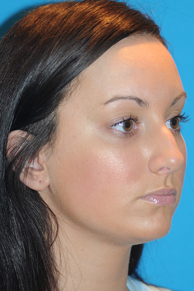 Rhinoplasty Before