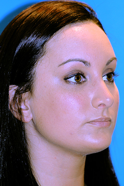 Rhinoplasty After