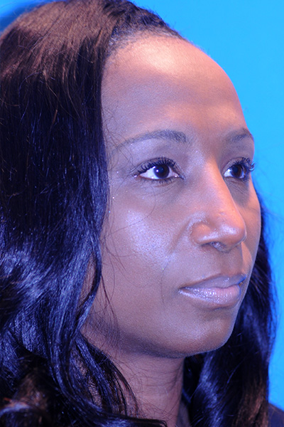 Rhinoplasty After Rhinoplasty After