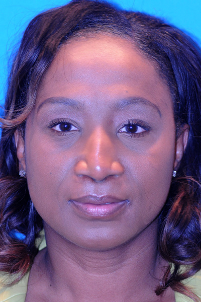 Rhinoplasty Before Rhinoplasty Before
