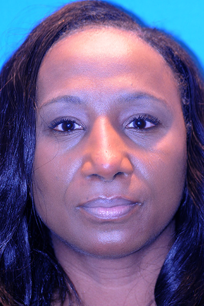 Rhinoplasty After Rhinoplasty After