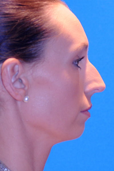 Rhinoplasty Before Rhinoplasty Before