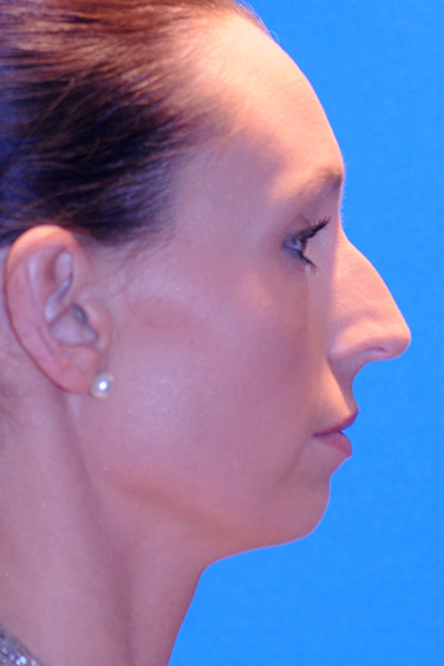 Rhinoplasty Before