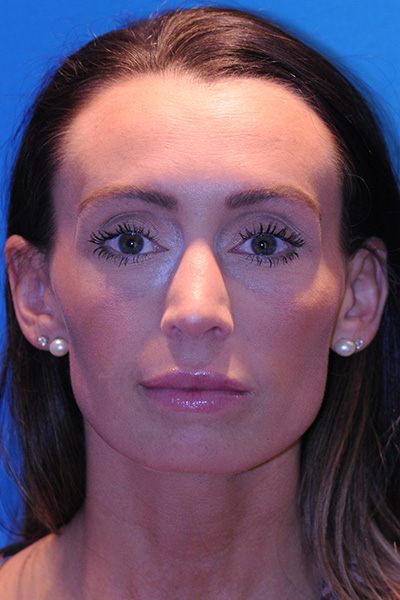 Rhinoplasty After