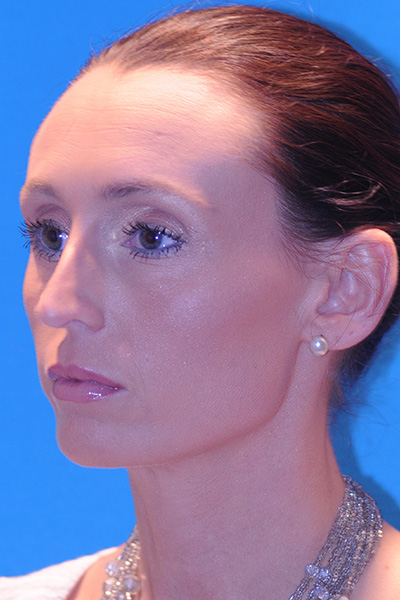 Rhinoplasty Before