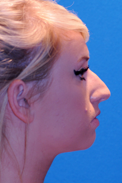 Rhinoplasty Before