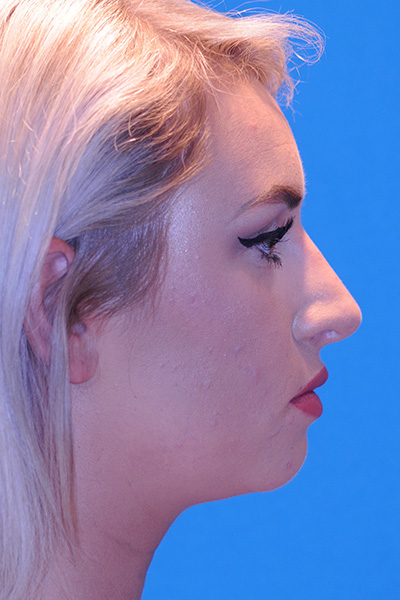 Rhinoplasty After