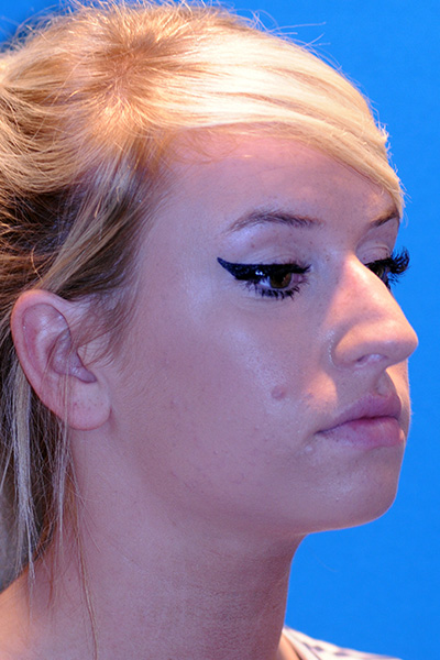 Rhinoplasty Before