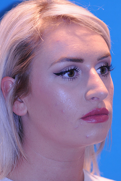 Rhinoplasty After Rhinoplasty After