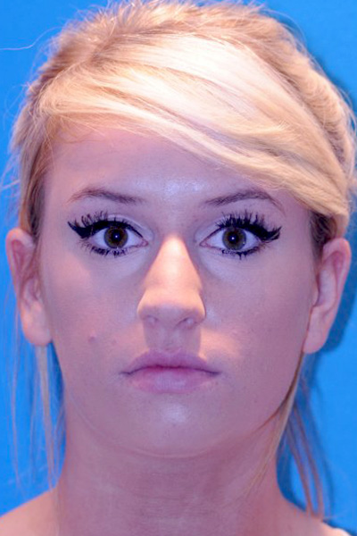 Rhinoplasty Before Rhinoplasty Before