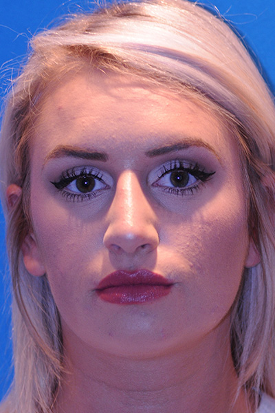 Rhinoplasty After Rhinoplasty After