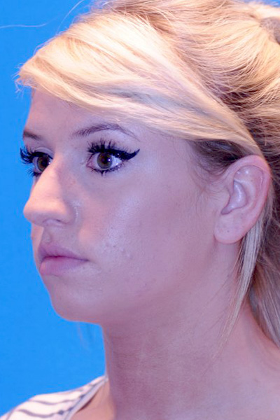 Before Rhinoplasty