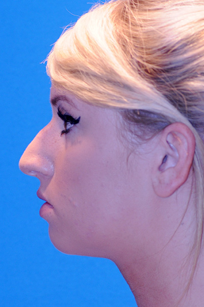 Before Rhinoplasty