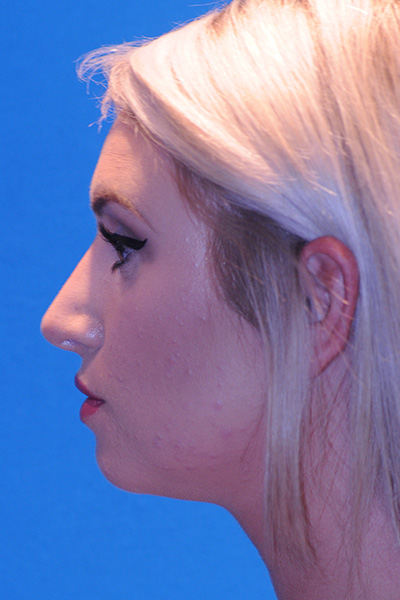 After Rhinoplasty