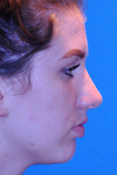 Rhinoplasty After