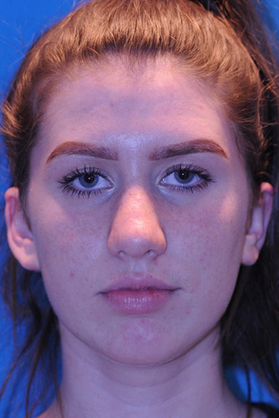 Rhinoplasty After