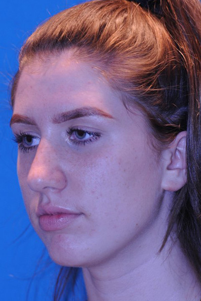 Rhinoplasty After