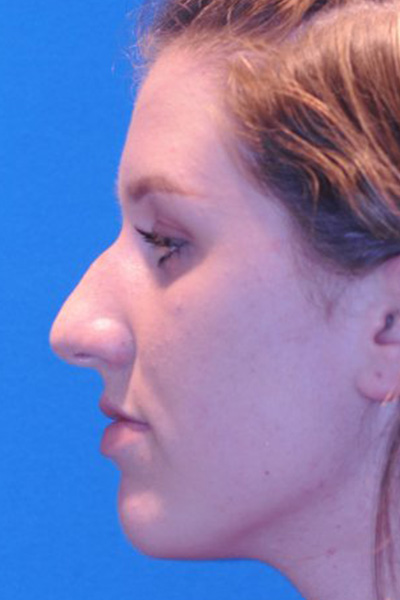 Rhinoplasty Before