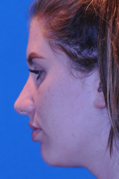 Rhinoplasty After