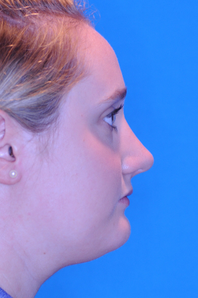 Rhinoplasty After