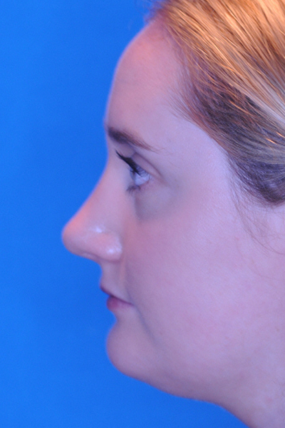 Rhinoplasty After