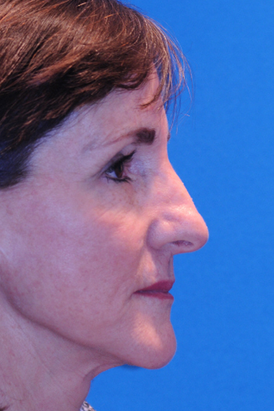 Rhinoplasty Before Rhinoplasty Before
