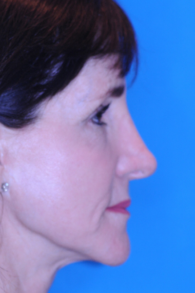 Rhinoplasty After