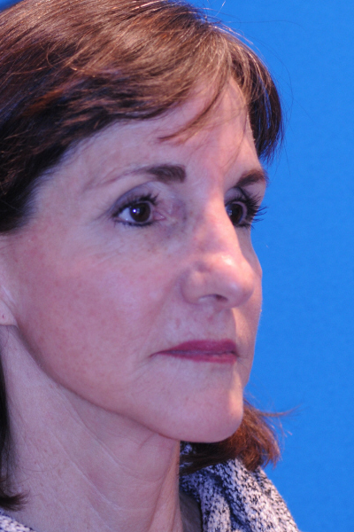 Rhinoplasty Before Rhinoplasty Before