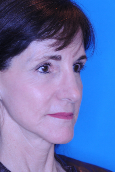 Rhinoplasty After Rhinoplasty After