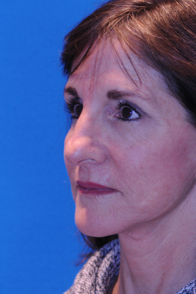 Rhinoplasty Before Rhinoplasty Before