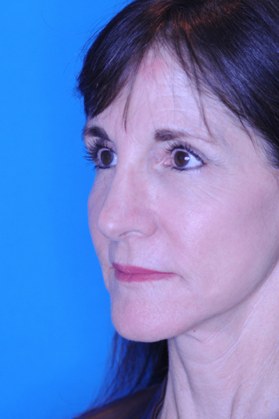 Rhinoplasty After Rhinoplasty After
