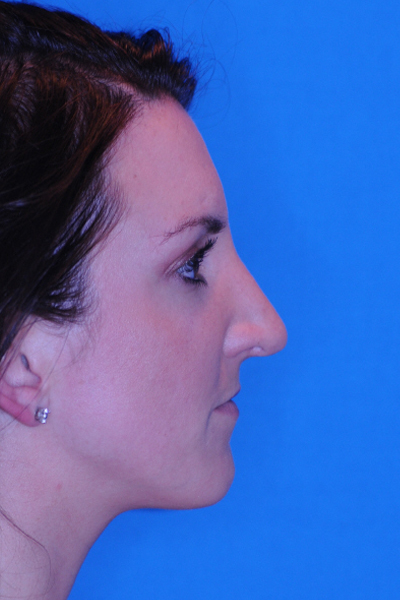 Rhinoplasty After