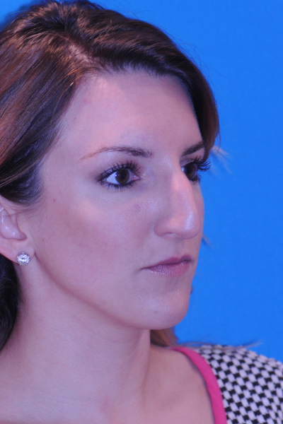 Before Rhinoplasty