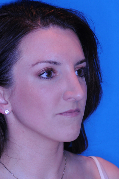 After Rhinoplasty