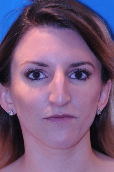 Before Rhinoplasty