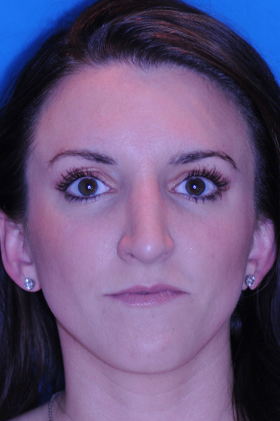After Rhinoplasty