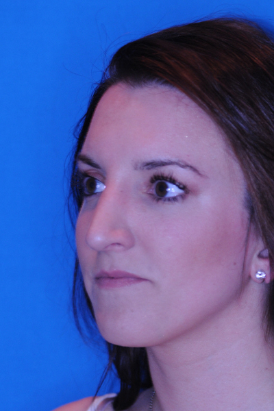 After Rhinoplasty