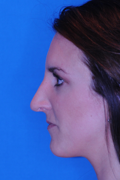 Rhinoplasty After