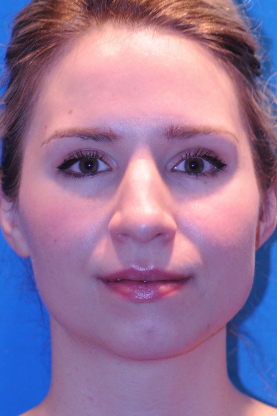 Rhinoplasty Before