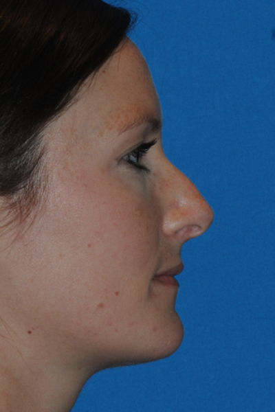 Rhinoplasty Before