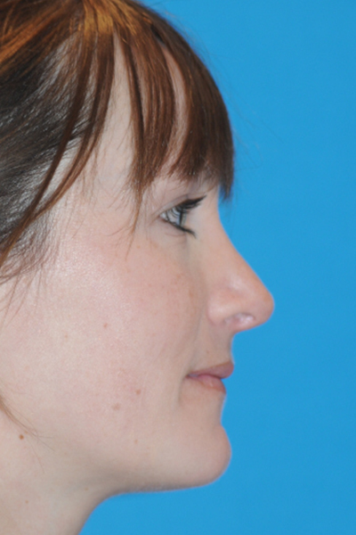 Rhinoplasty After