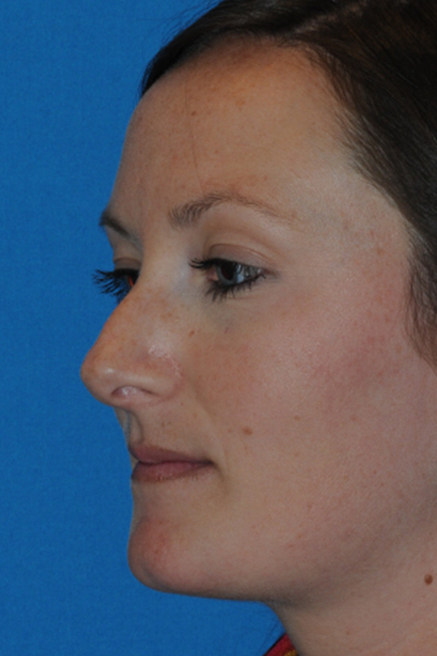 Rhinoplasty Before