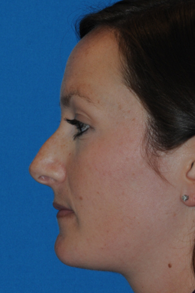 Rhinoplasty Before