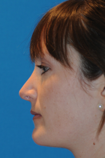 Rhinoplasty After