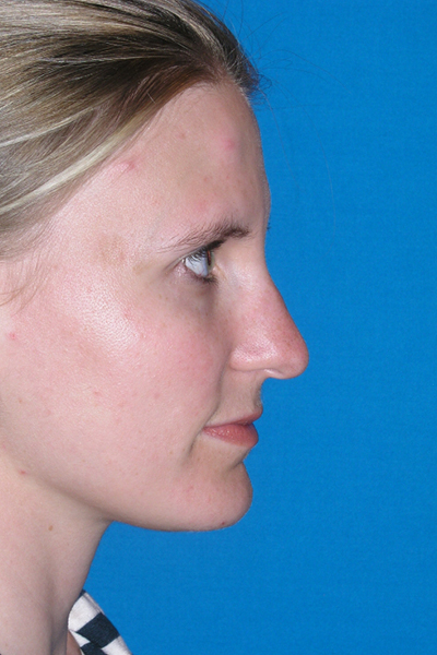Before Rhinoplasty