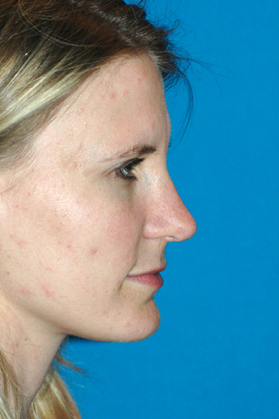 After Rhinoplasty