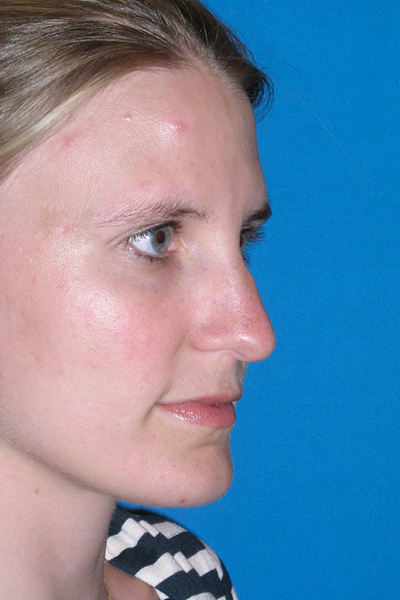 Before Rhinoplasty