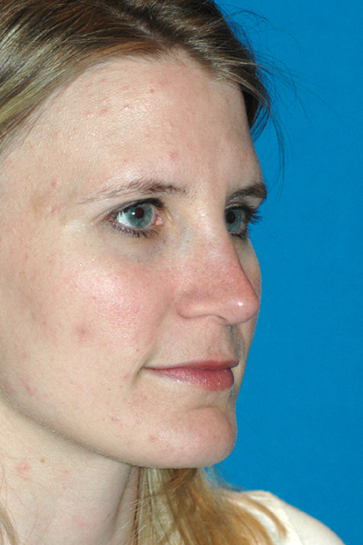 After Rhinoplasty