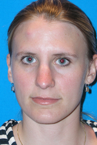 Before Rhinoplasty